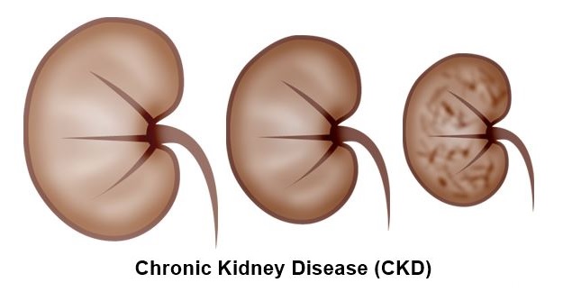 Chronic-Kidney-Disease.jpg