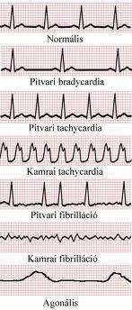 hogyan lehet eltávolítani a tachycardia magas vérnyomással