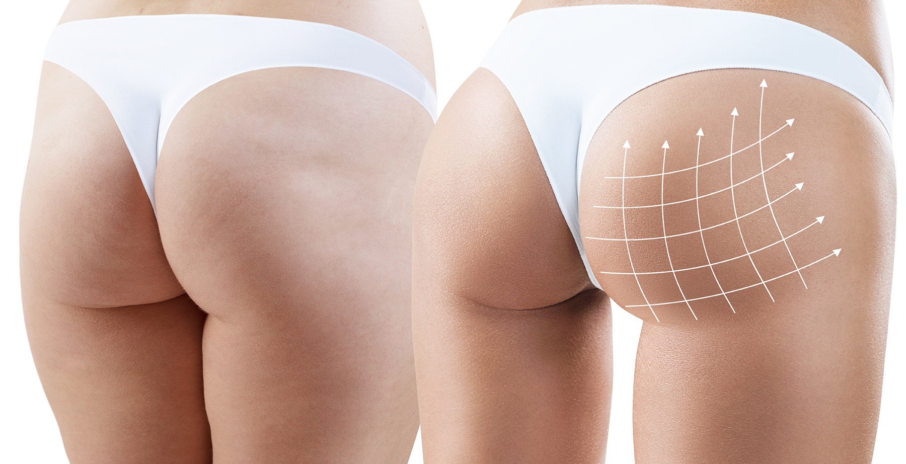buttock augmentation.jpg