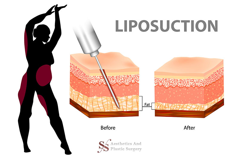 Liposuction.jpg