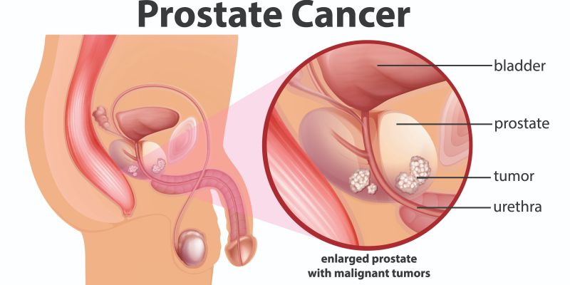 Prostate Cancer.jpg